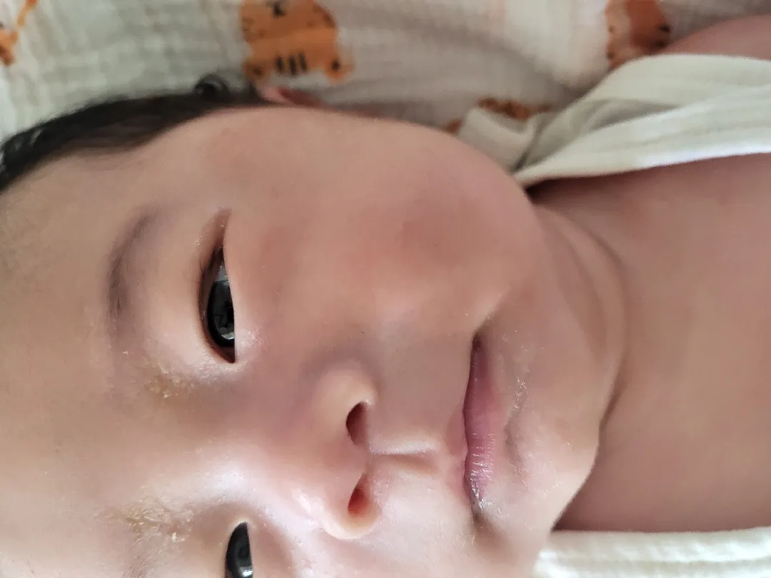 눈썹주변에 노란각질?딱지? 어떻게 해야하나요