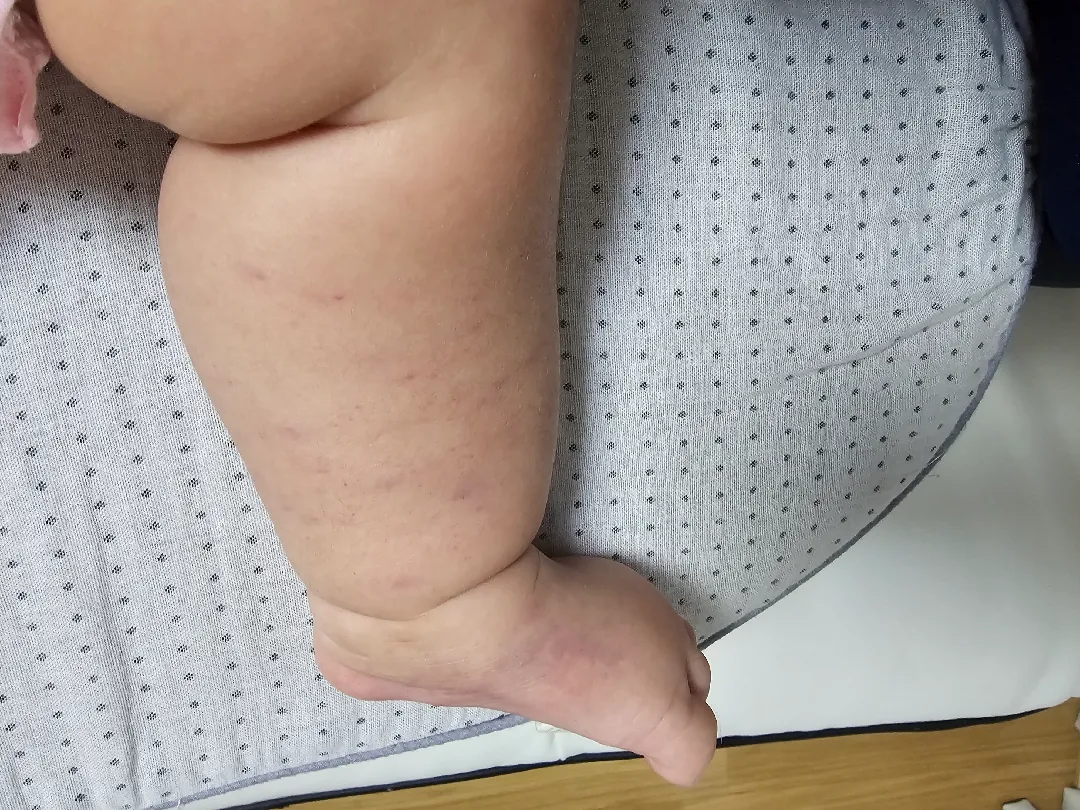 슬링착용한후 애기다리 멍들었어요