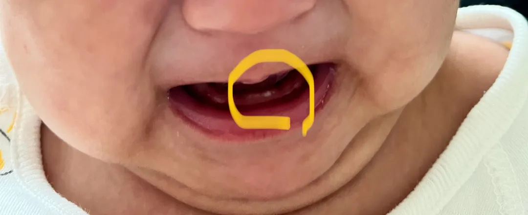 아기 잇몸에 혹시 진주종…???