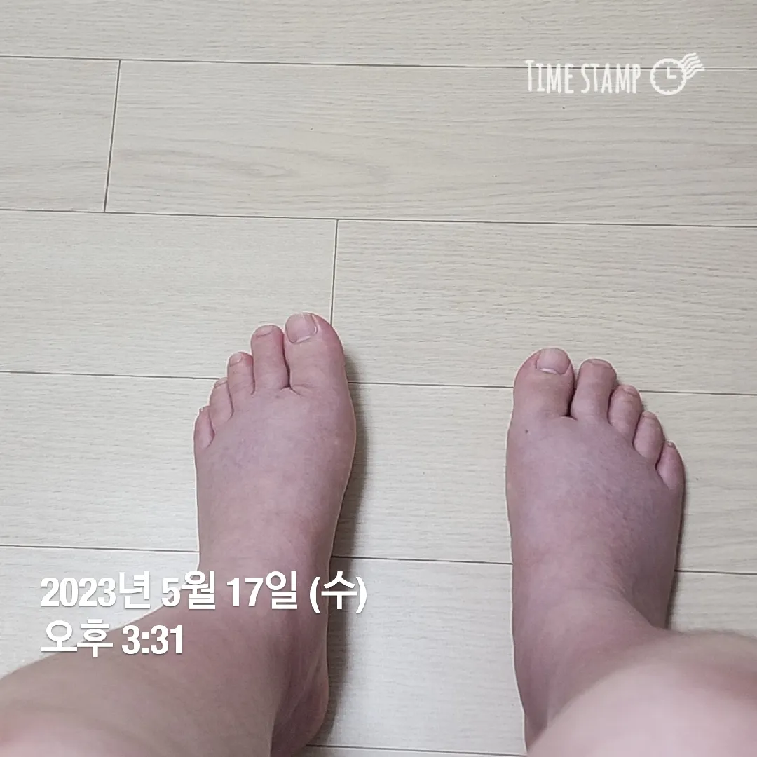 37주인데 발 붓기 괜찮나요