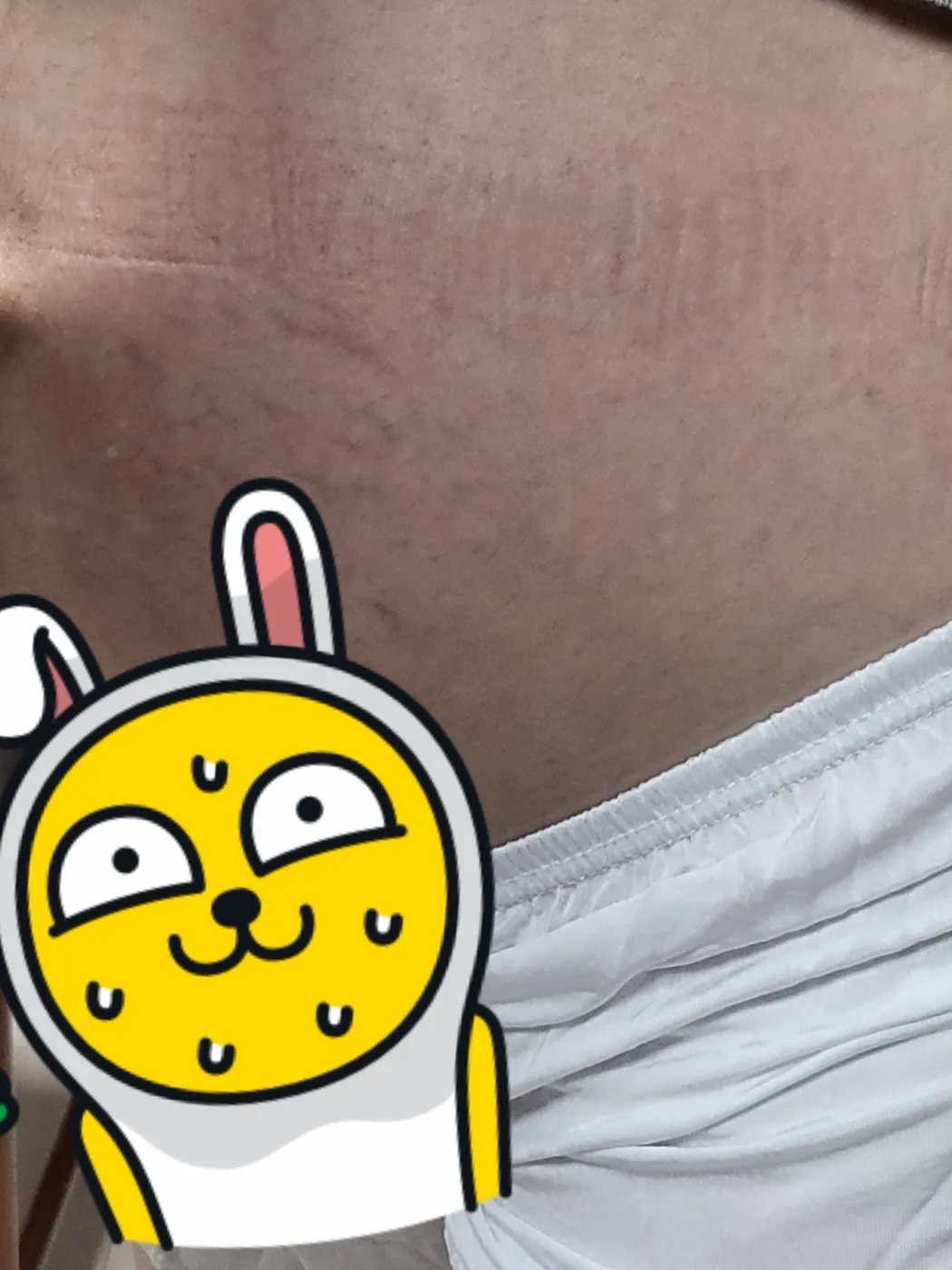 (사진주의) 이게 튼살 맞죠..?ㅠㅠ