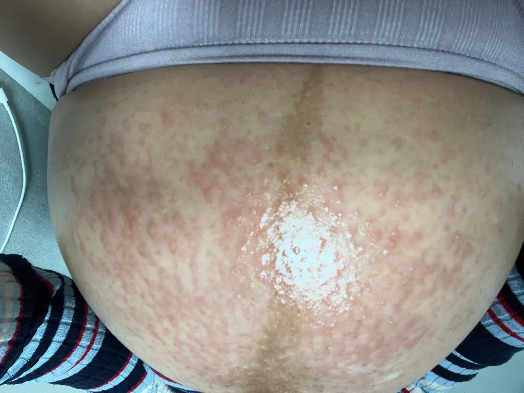 (38w4d) 제 피부 좀 봐주세요ㅠㅠ
