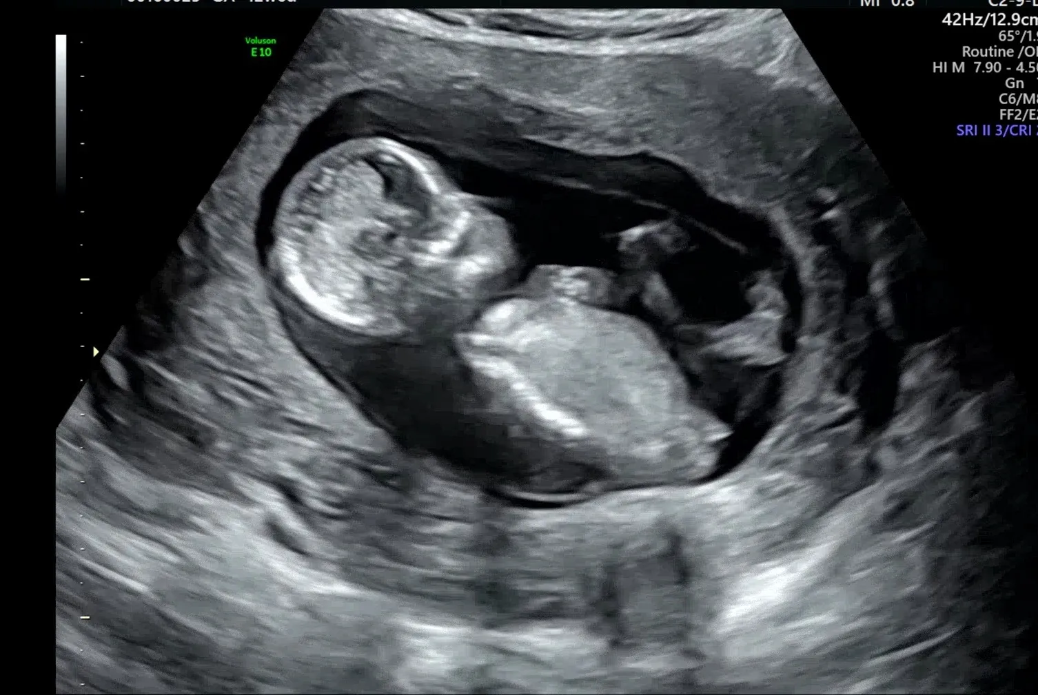 12w6d