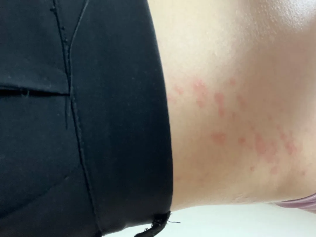 대상포진..?소양증...?