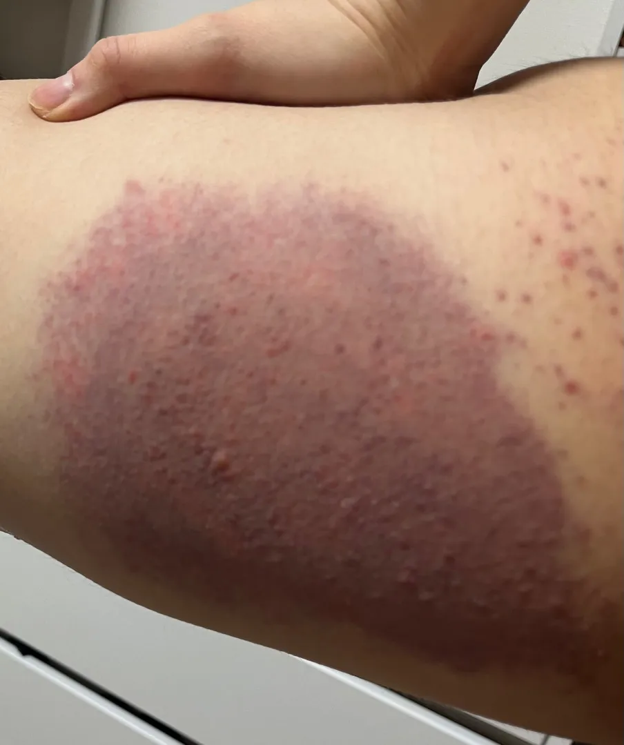 임신소양증..?접촉성 피부염??도대체 뭘까요..현재 스테로이드 약 복용중입니다 ㅠㅠ봐주세요