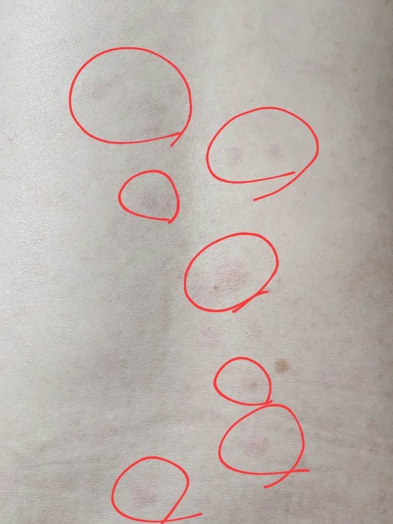 이제 5주차인데,, 다들 피부 괜찮으세요?