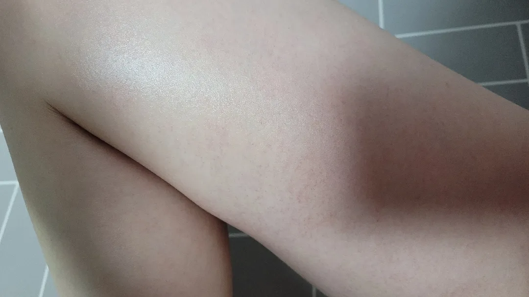 18주)다리 전반적으로 멍든것처럼