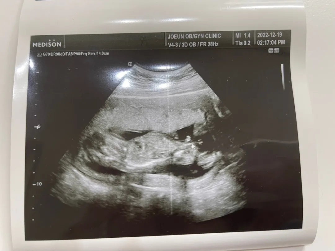 15주 4일! 성별 남자라는데 맞는거겠죠?