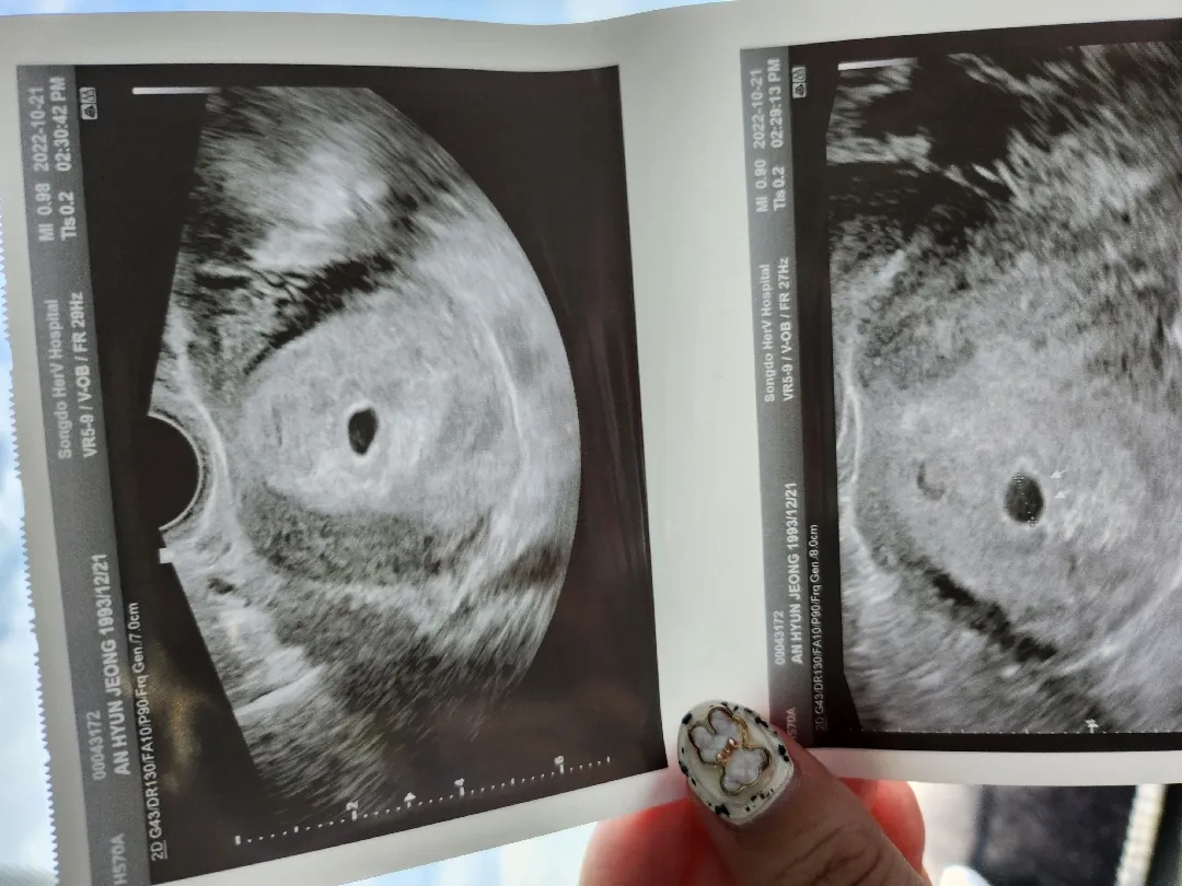 5주차 초음파 보고왔어요👶🤍