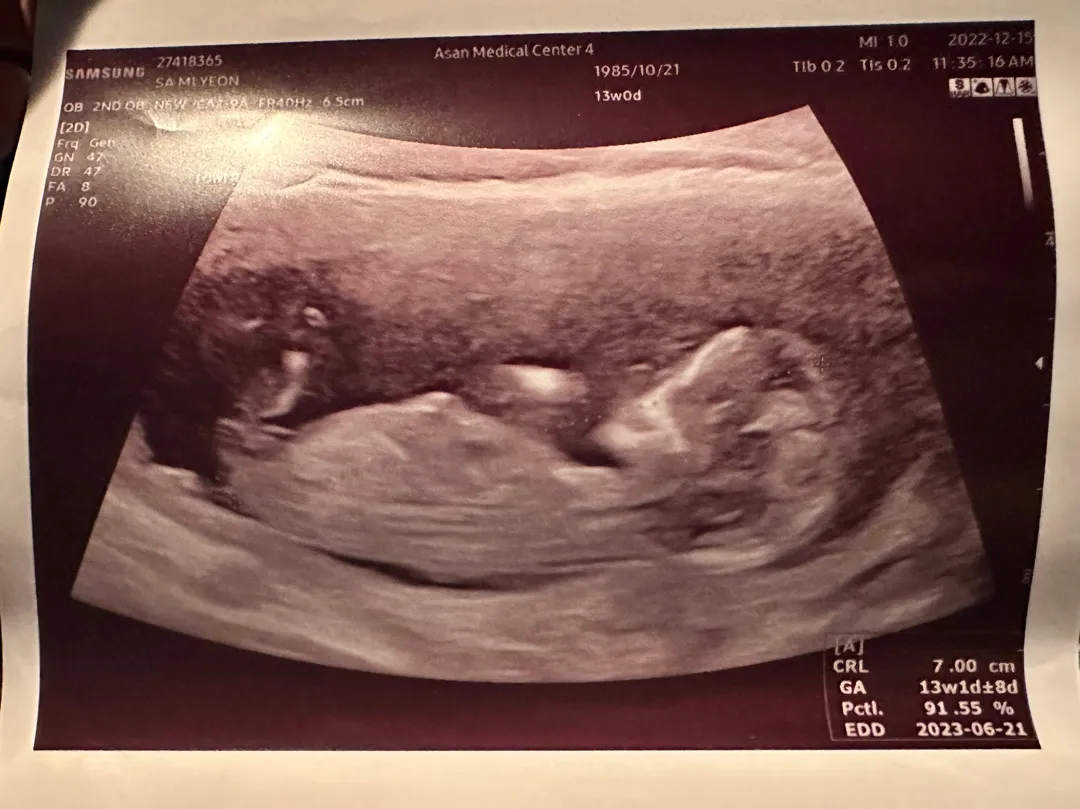 13주5일!! 각도법 고수님들 알려주세요💗