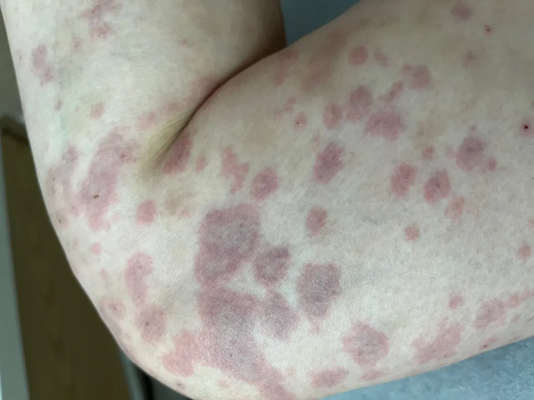 대구피부과 추천해주세요!(임신소양증)*혐주의