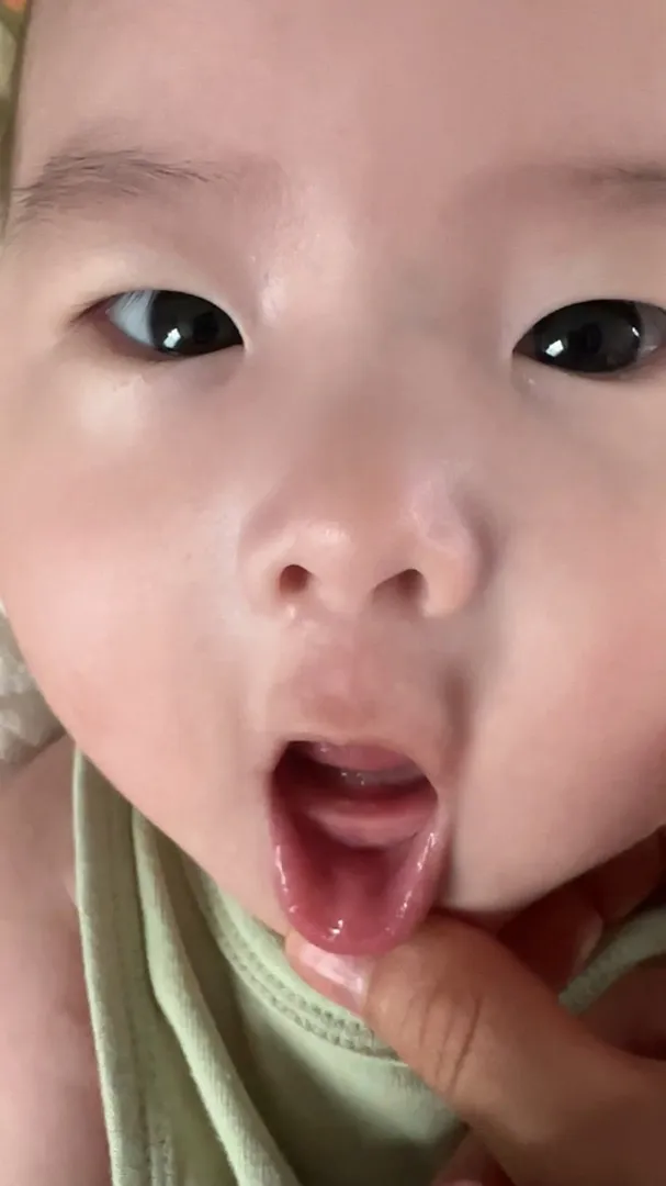 잇몸에 이 나려는 구멍..?