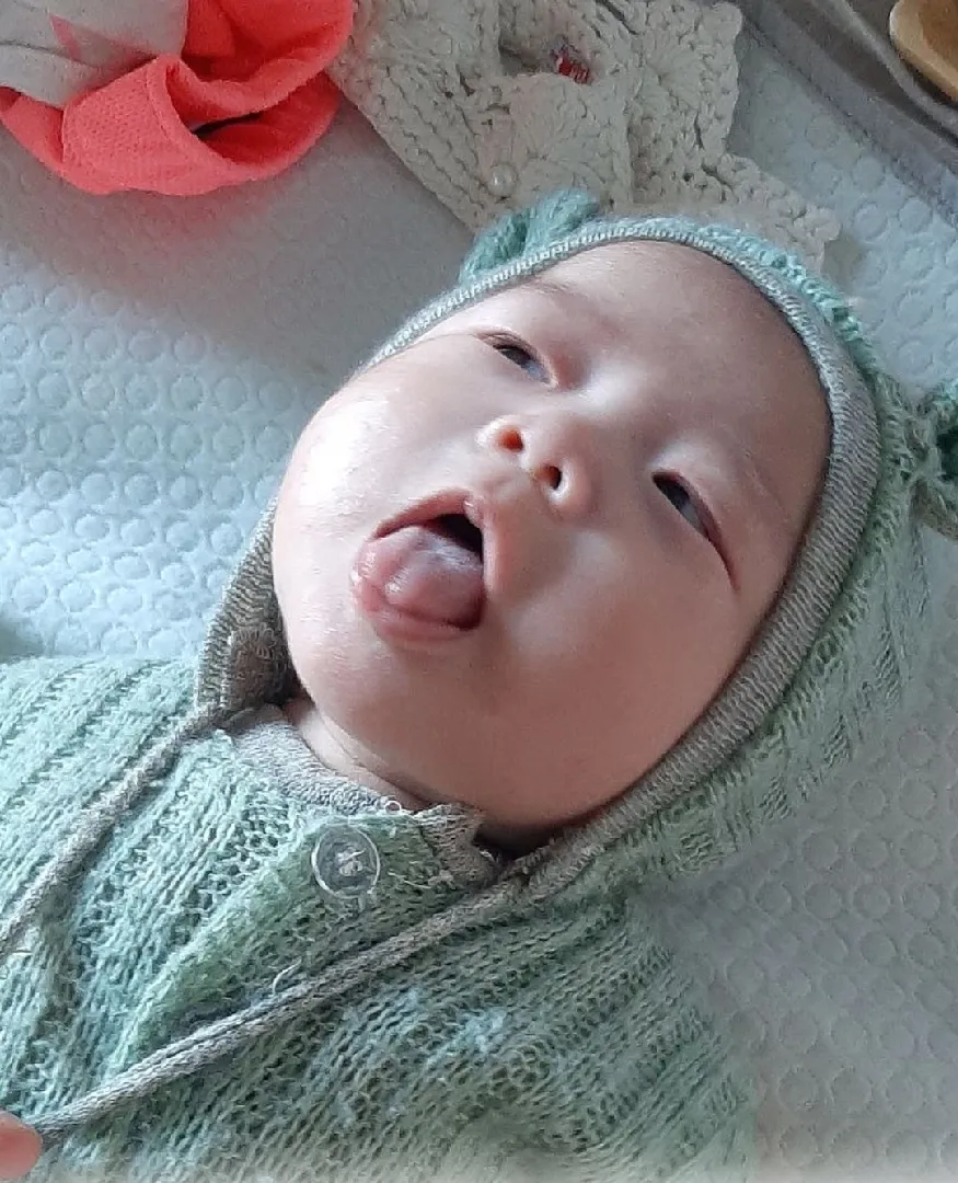 아가 설소대 수술 고민