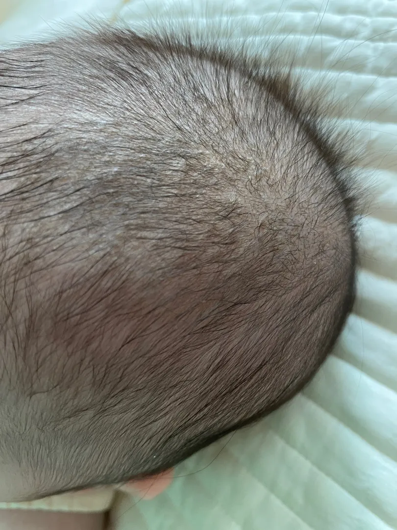 두피각질?