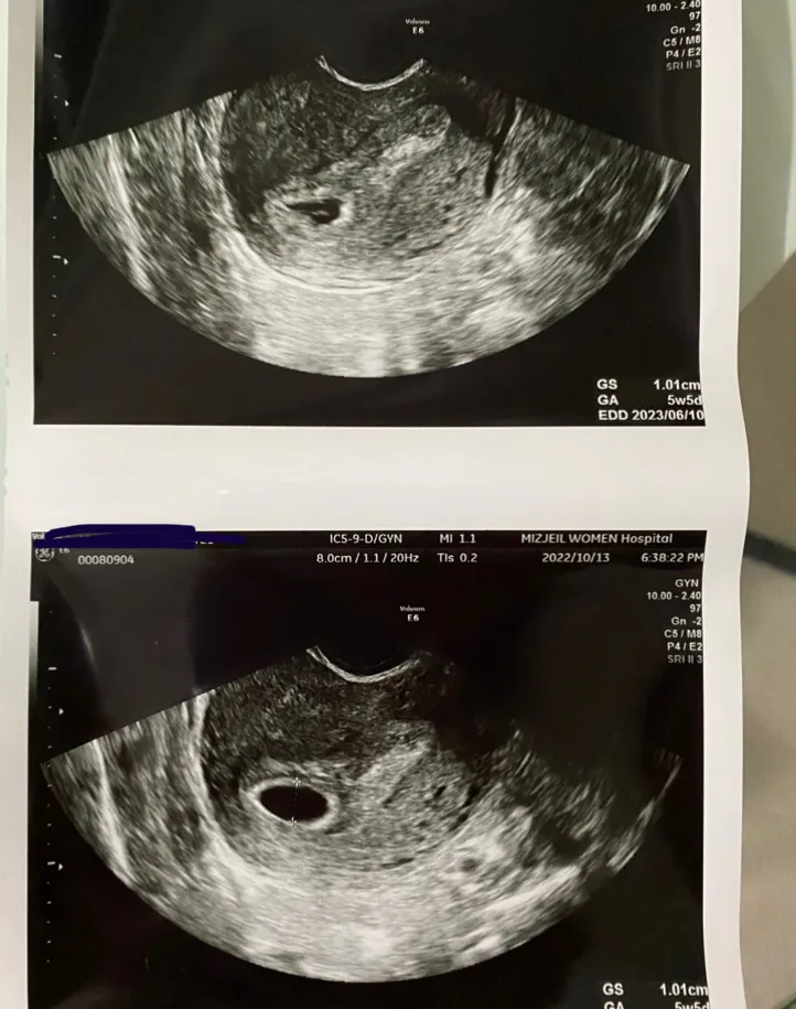 5주 3일차라는데 저거도 난황맞을까요?