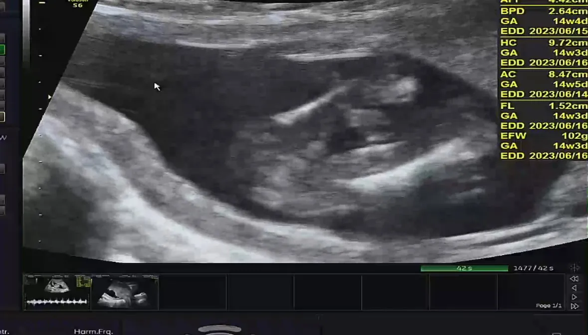 14주3일차 초음파 성별한번만 부탁드림니댜!!!!