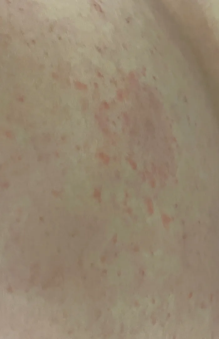 배쪽 피부에 알러지? 두드러기?