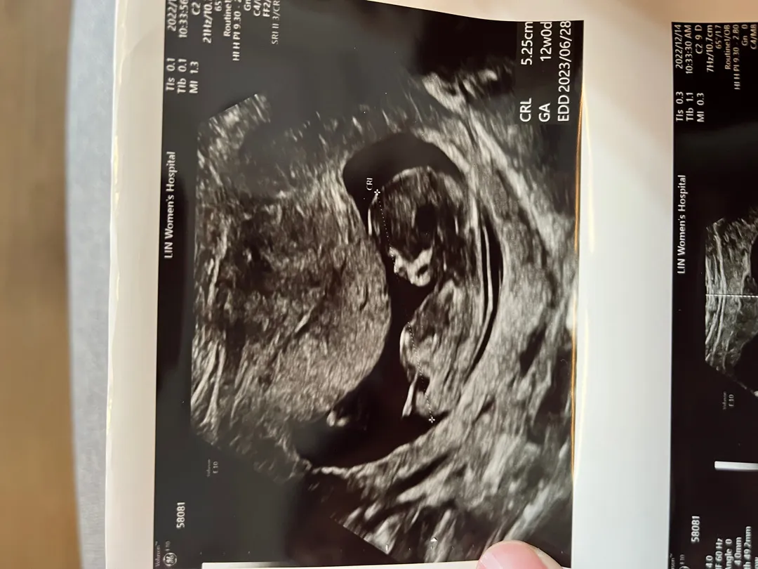 12주 기형아검사 마치고왔어요!