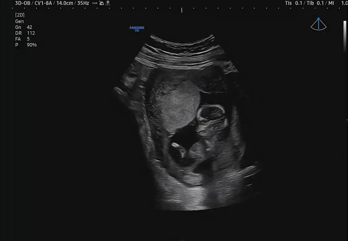 12주2일 성별 각도법으로 보일까요??