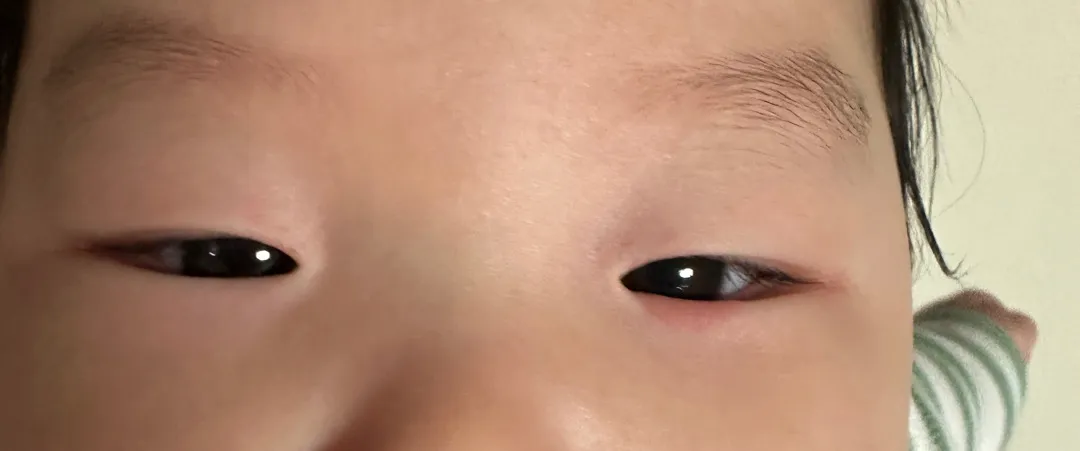 눈밑 피부 봐주세요