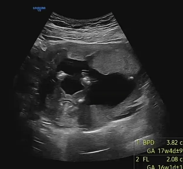 16주6일 딸?아들? 뭘까요?ㅜ