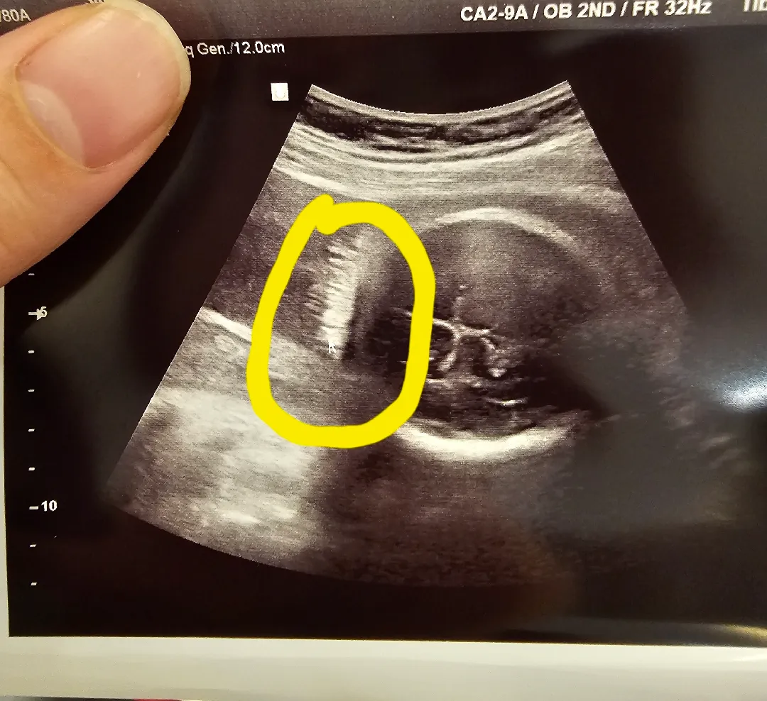 초음파상 아기 머리카락ㅎㅎ