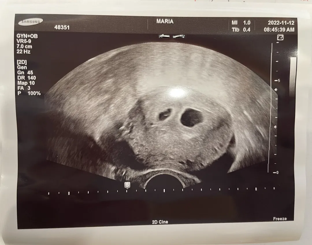 5주 3일차에 아기집보고왔어요~!