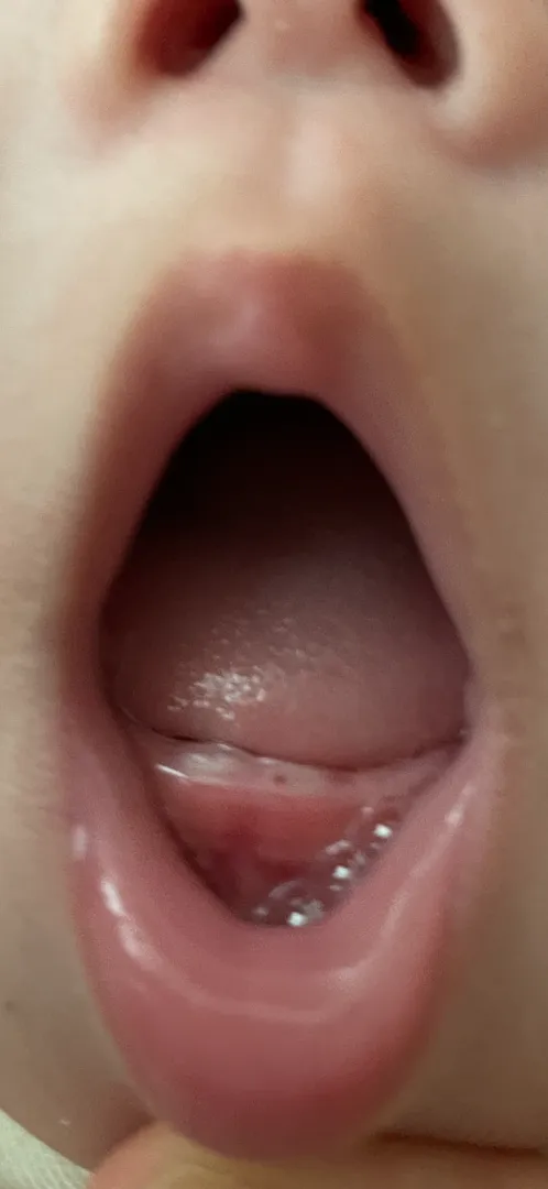 4개월아기 치아