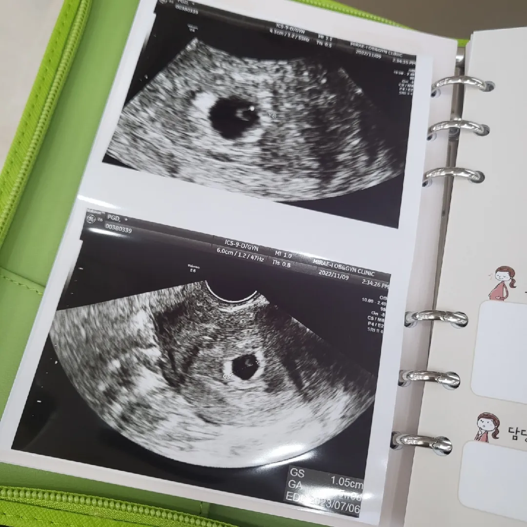 오늘 아기집👶🏻난황까지 보고 왔어요:)