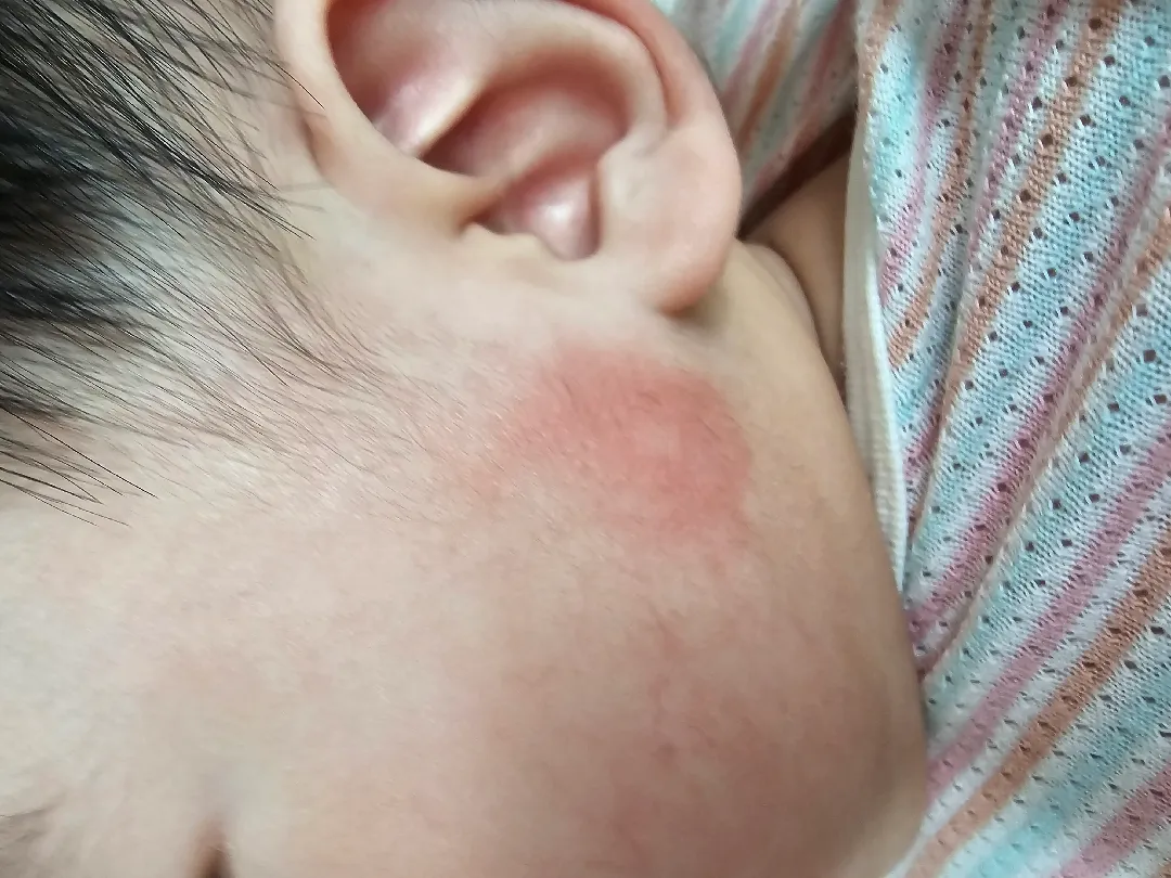 고구마 알레르기 일까요?ㅜㅠ