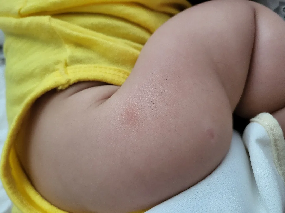 팔에수포같은게있는데요