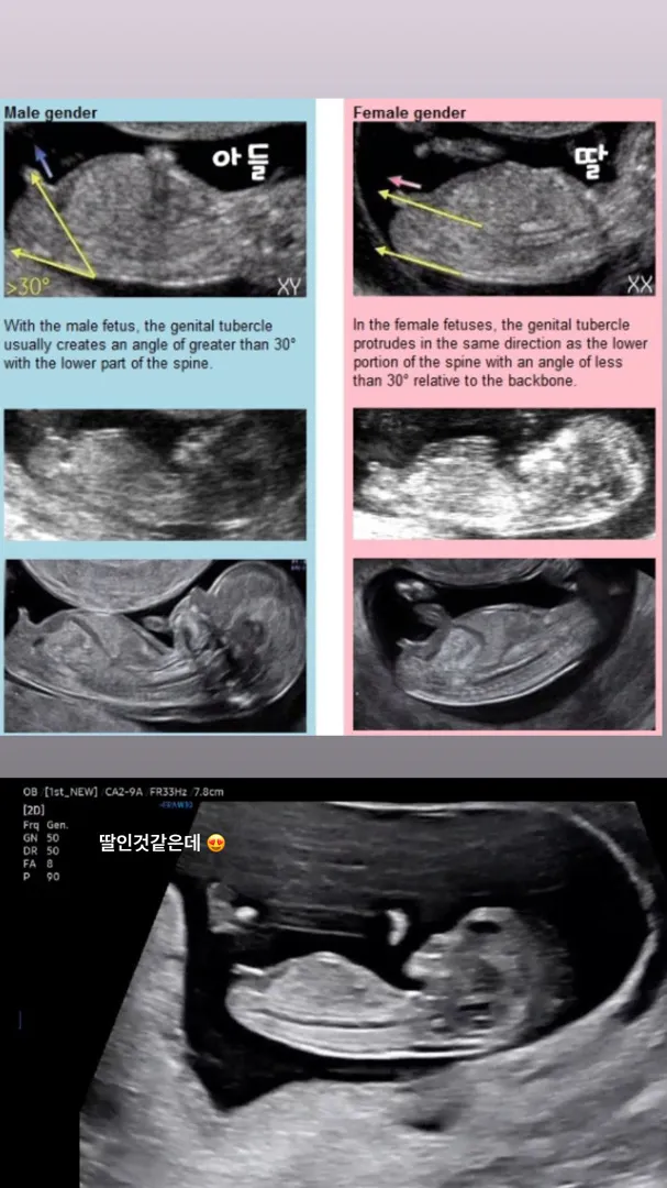 12 주 각도법좀 봐주세요