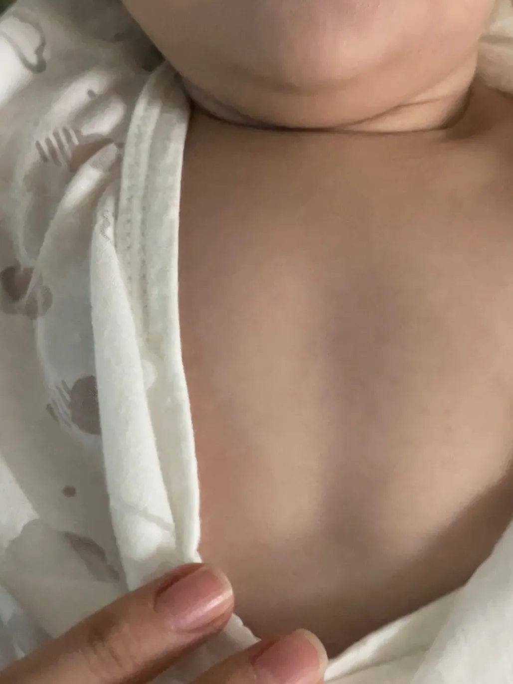 후두천명 후두연화증