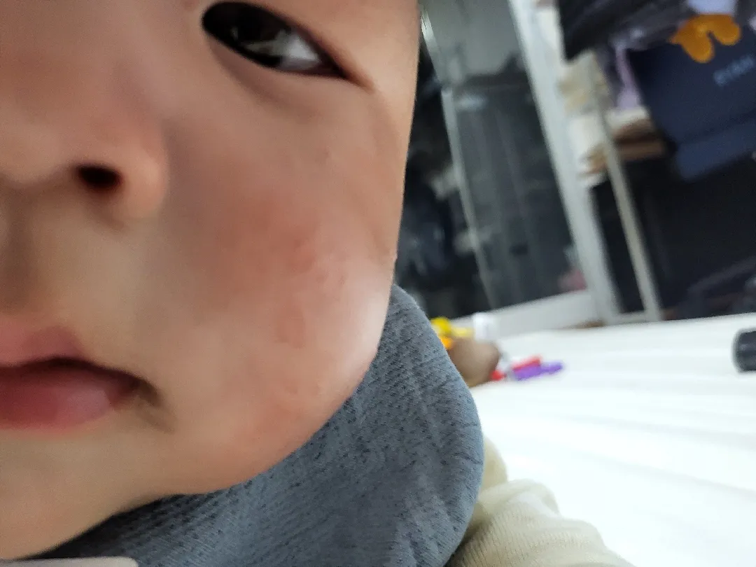 습진,아토피에 좋은 로션 추천해주세요~