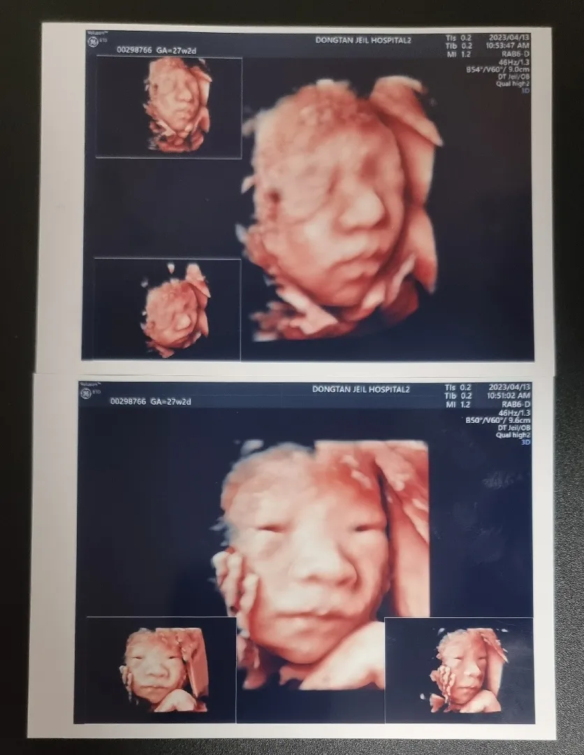 27주 입체초음파 눈뜬아기🫣