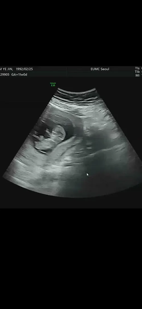 11주 기형아 검사 하구 왓어요 ㅎㅎ