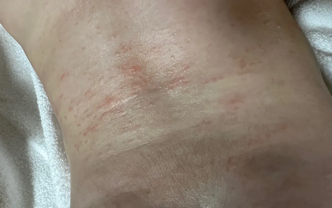 아기 땀띠 진짜 어떡하죠 ㅠㅠ
