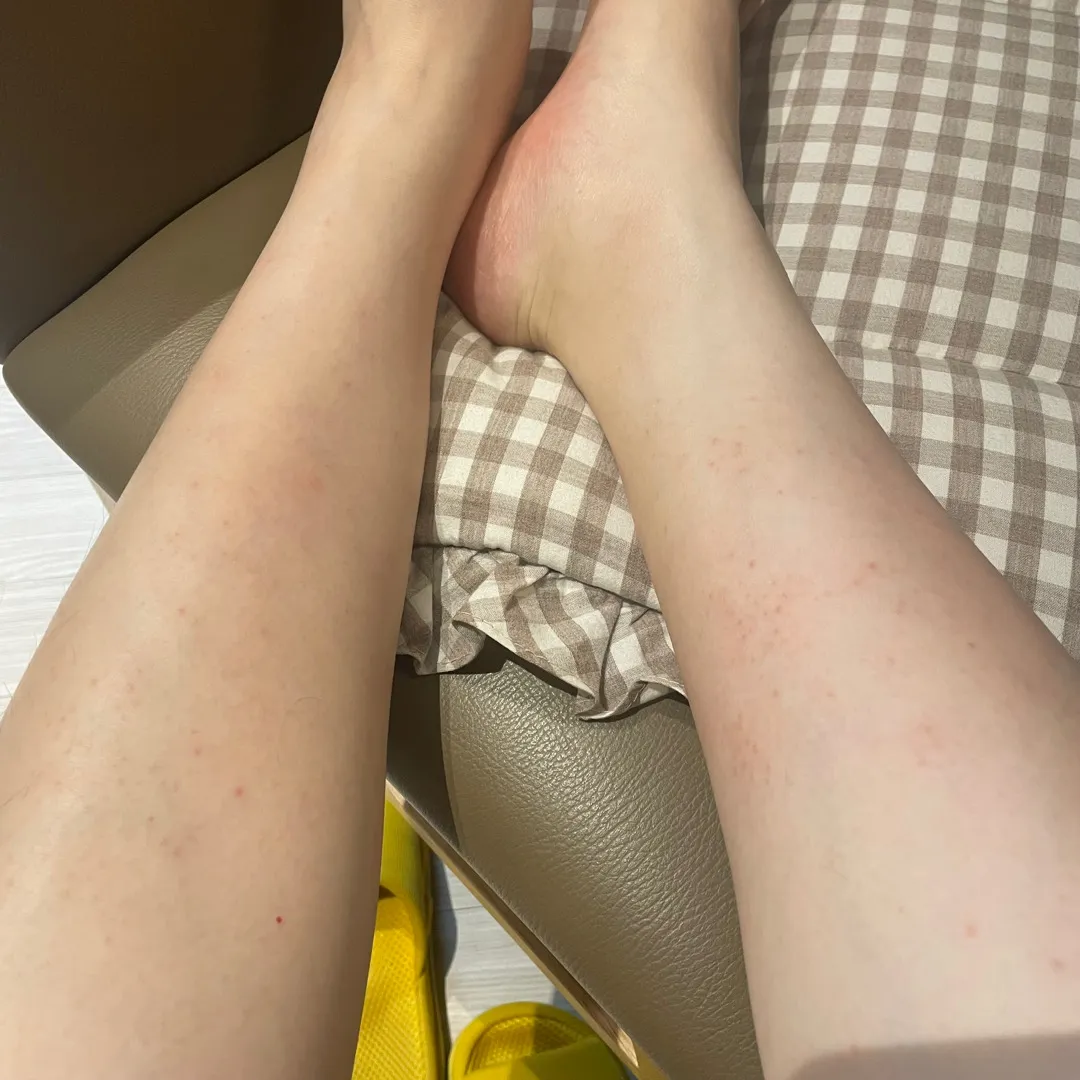 임신소양증일까요?(사진있어요ㅠ)