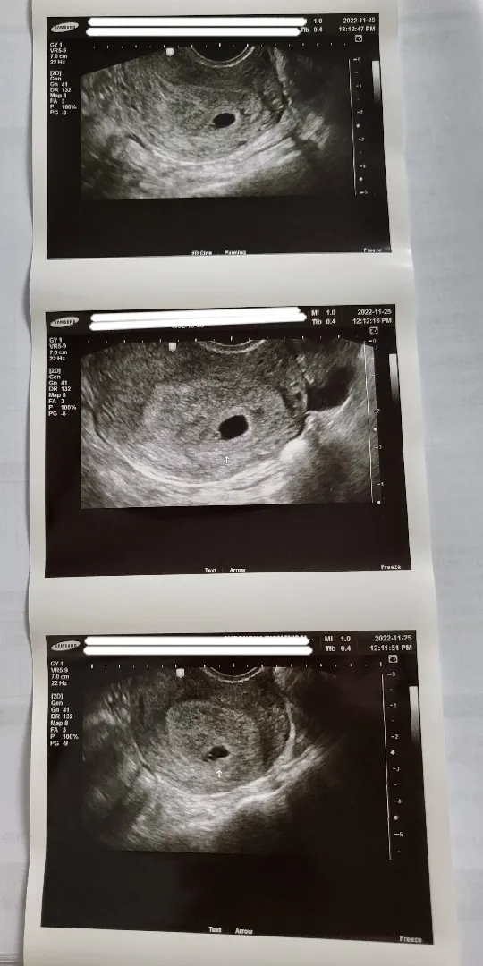 [6주 1일] 난황확인,애기집작음 