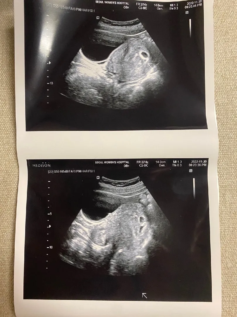 세쌍둥이 아기집 보고왔어요 ㅎㅎ