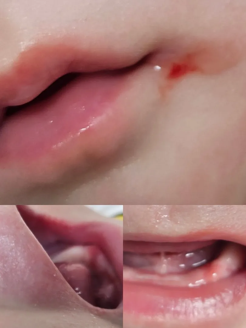 잇몸