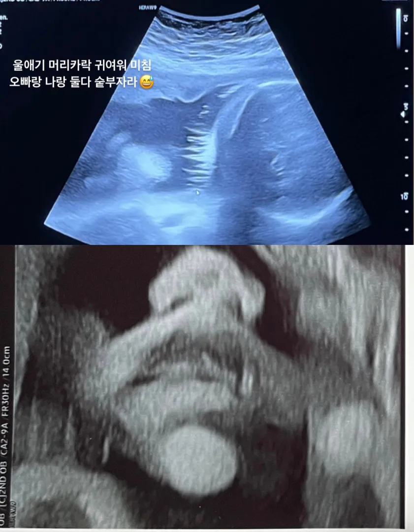 32주2일 애기머리카락보고와떠요!!