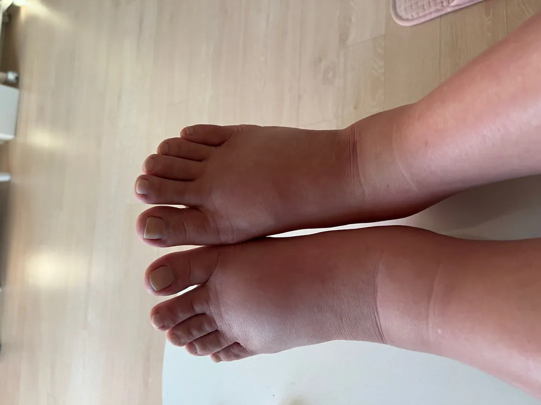 다리 붓기