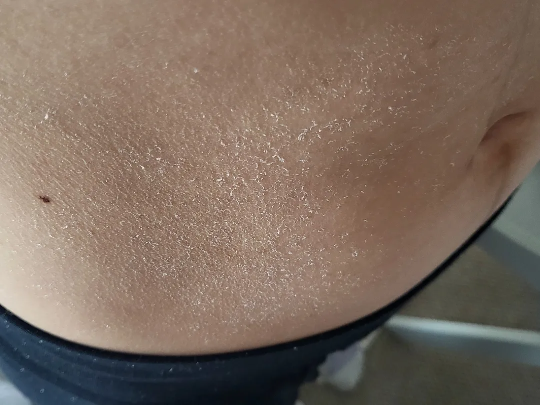 출산 후 배 피부 각질 (사진첨부)