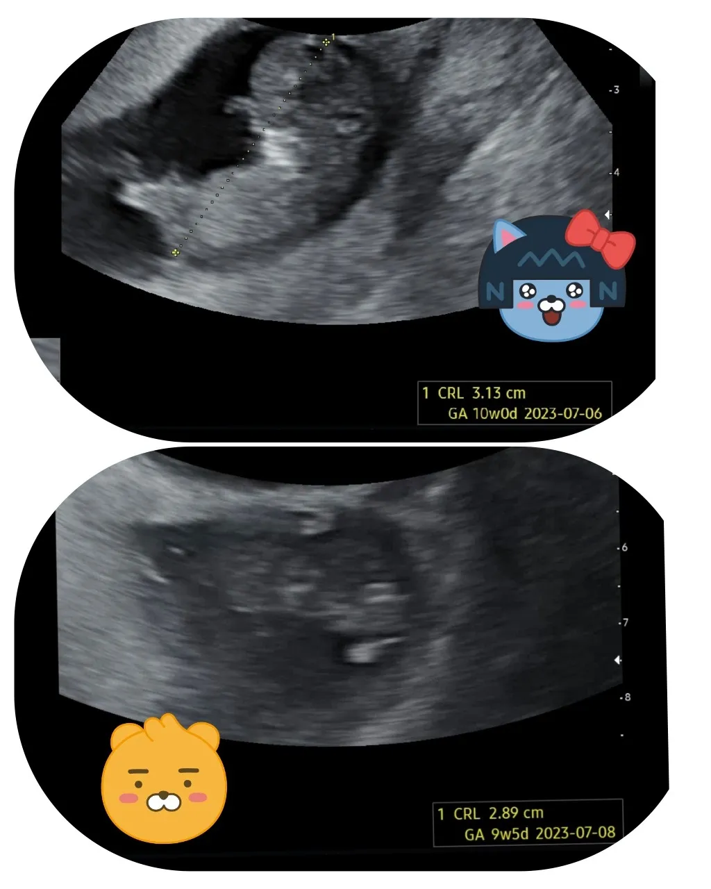 9주6일에 만난 둥이 아가들❤️