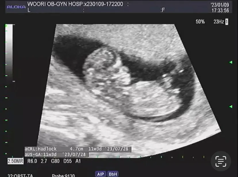 11일주 4일 저희 아이 성별 각도법 좀 같이 봐주세요