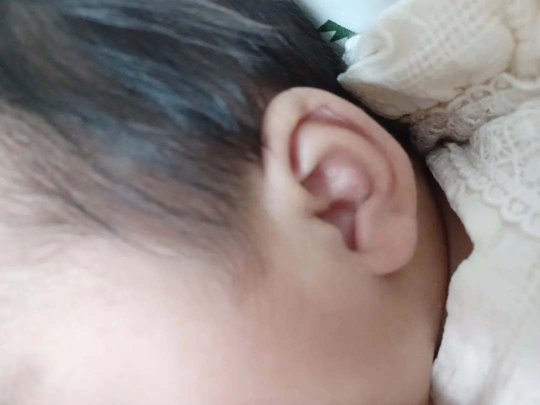 애기 귀에 좁쌀여드름같은게 있어요