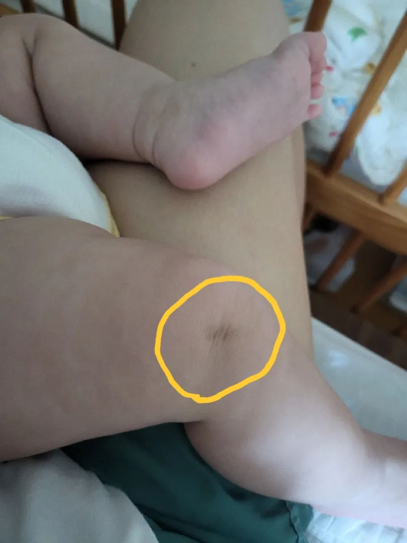 아기 무릎 옆 착색? 굳은살?