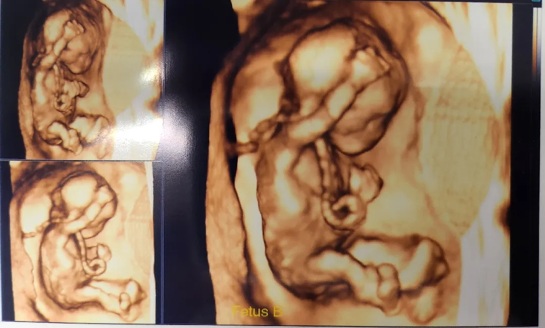 일란성 쌍둥이 태아보험 드신분있나요?