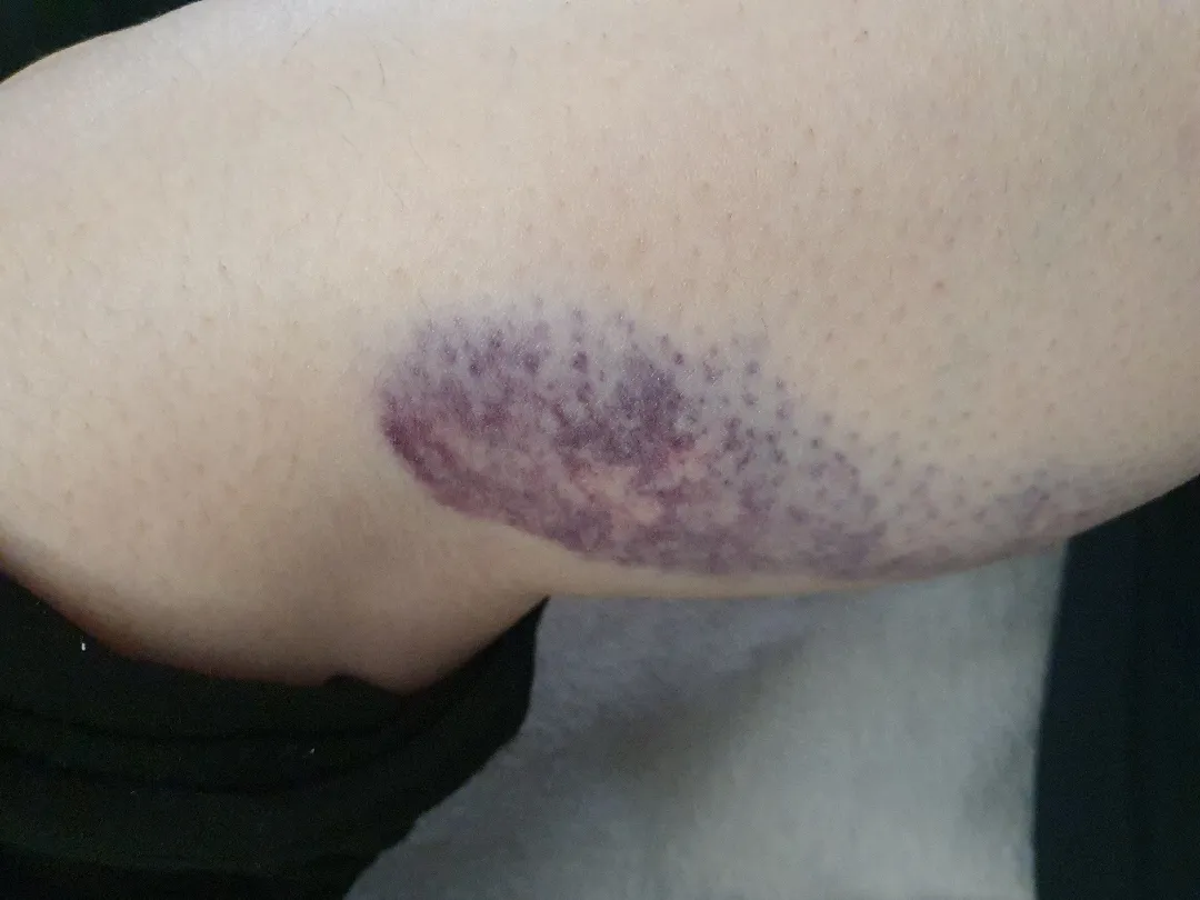 (사진주의)18주 와이프 종아리에 크게 멍이 생겼는데 괜찮을까요.?